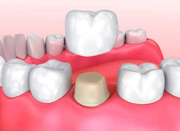 coronas dentales para niños y adultos